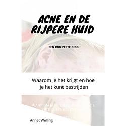 Foto van Acne bij volwassenen